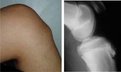 LA MALALTIA D’OSGOOD – SCHLATTER