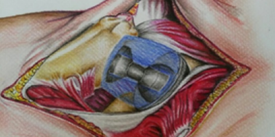 Ilustración de prótesis de cadera