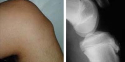 LA MALALTIA D’OSGOOD – SCHLATTER